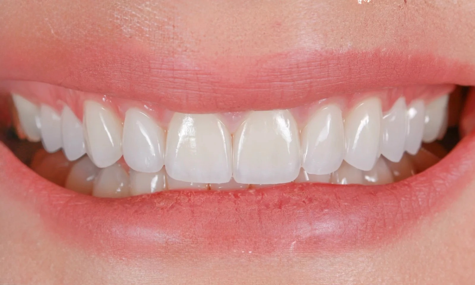 After treatment: a comprehensive smile makeover utilizing custom ceramic restorations to correct previous aesthetic discrepancies, resulting in properly proportioned, naturally translucent teeth.